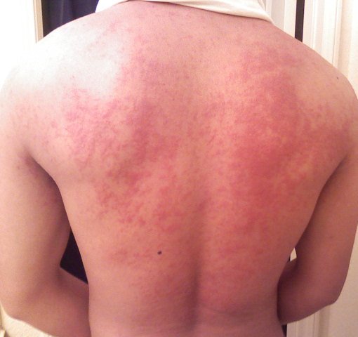 hives on a person's back